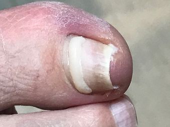 Onyfix nagelkorrigering